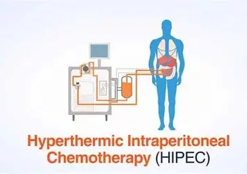 HIPEC